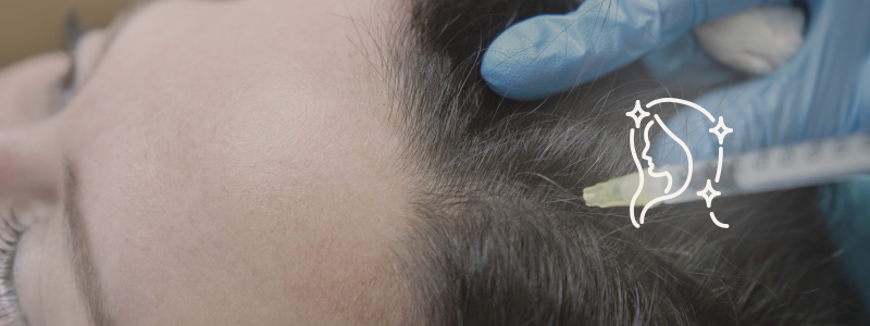 Intradermoterapia Capilar